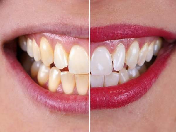 5 erros que o impedem de ter dentes&nbsp;brancos