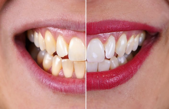 5 erros que o impedem de ter dentes&nbsp;brancos